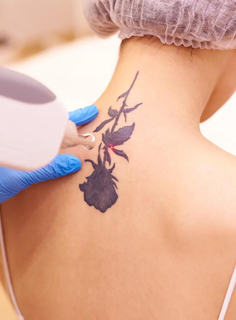 Pain-free tattoo removal
